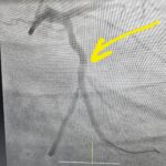 heartsurgery