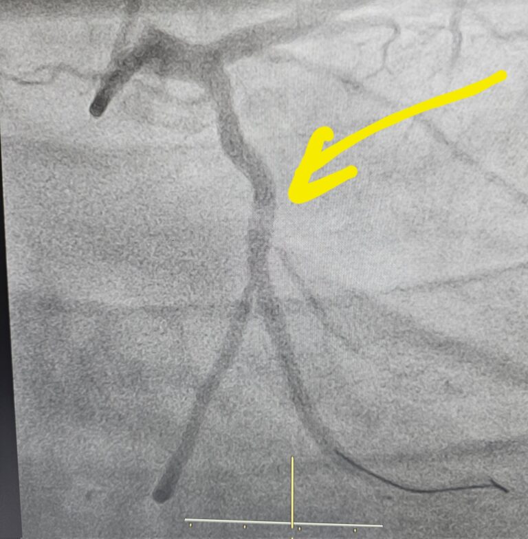 heartsurgery